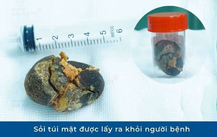 Viên sỏi túi mật kích thước lớn khiến túi mật bị giãn to, gây áp lực lên các cơ quan xung quanh. Ảnh: BVCC.